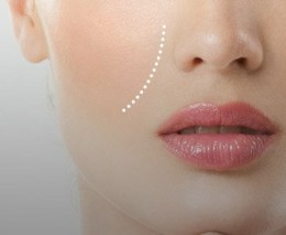 Light Lift Thread 2G Soft нить расс., с насечками, 3,5х250мм с режущими иглами 0,8ммх100мм 4шт.